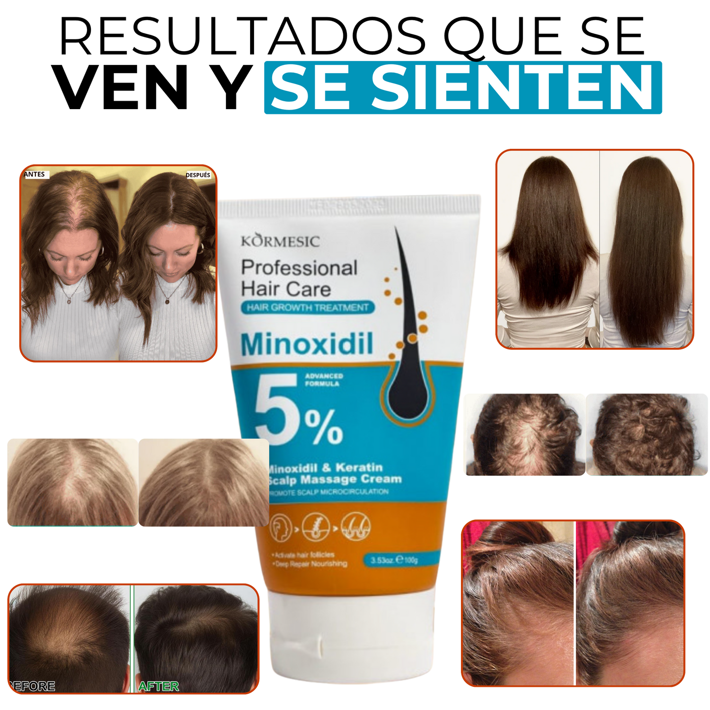 Crema crecimiento cabello 5% Minoxidil